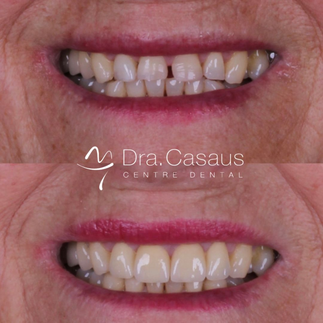 carillas-dentales-ceramica-disilicato-01-2