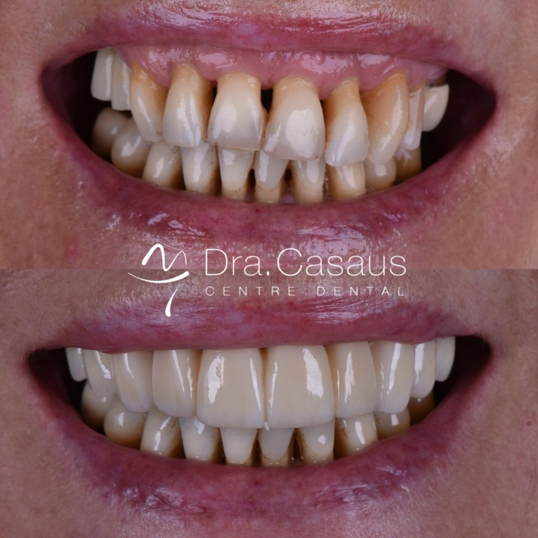 carillas-dentales-el-prat-clinica-dental-casaus-003