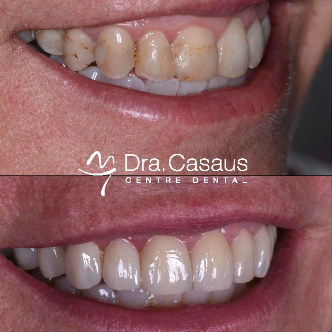 carillas-dentales-el-prat-clinica-dental-casaus-004