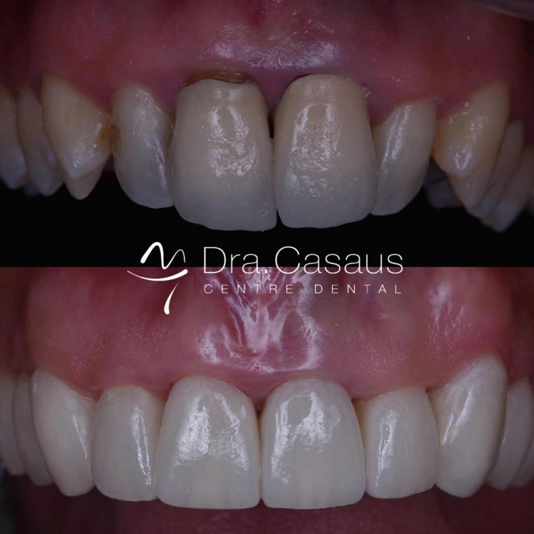 carillas-dentales-el-prat-clinica-dental-casaus-006